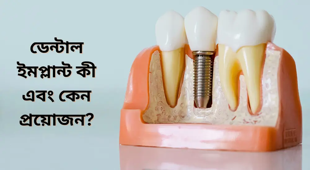 ডেন্টাল ইমপ্লান্ট কী এবং কেন প্রয়োজন?